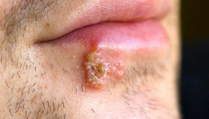 Blisters – Causes and how to heal blisters quickly