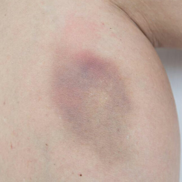 Easy bruising – Causes and treatments