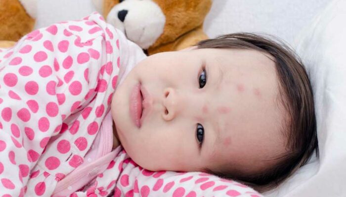 Here’s How to Identify Common Insect Bites