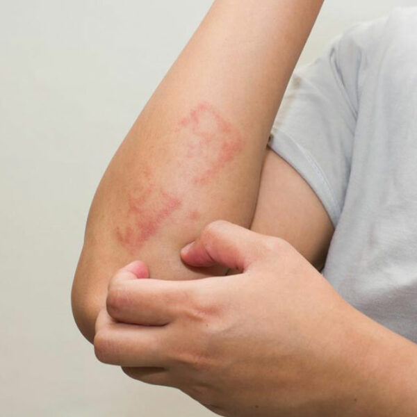 Here’s all that you need to know about scabies skin rash