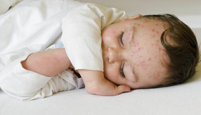 Here’s how to treat skin rashes in babies