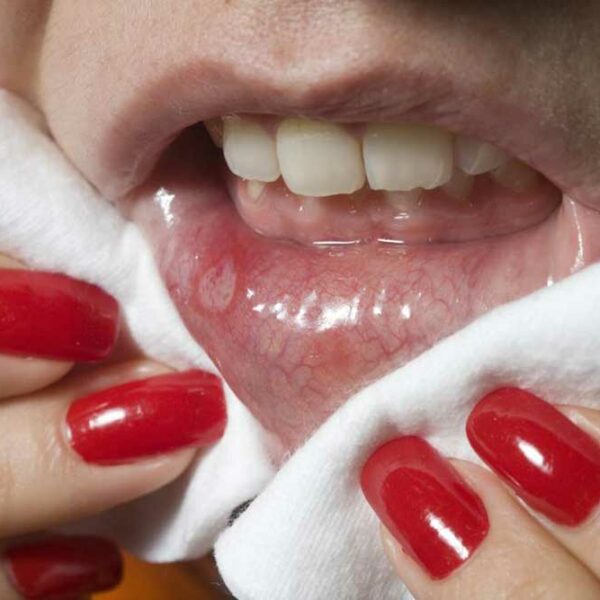 Mouth Cancer – Causes and Symptoms