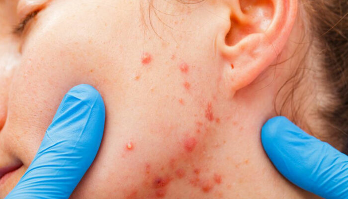 What you need to know about the types and stages of myeloma