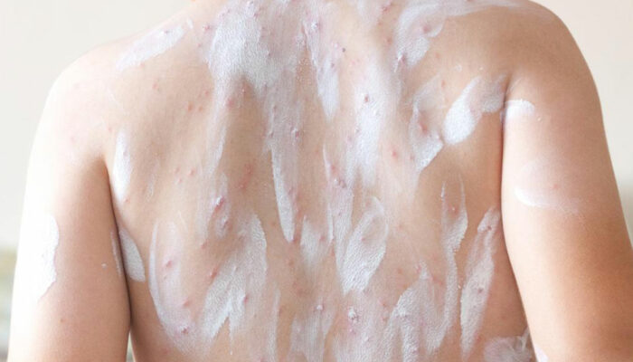 Atopic Dermatitis – Treatment Options That Can Be Tried at Home