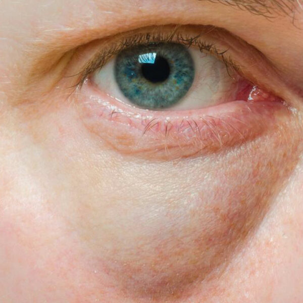 Bags Under the Eyes – Symptoms, Causes, and Treatment