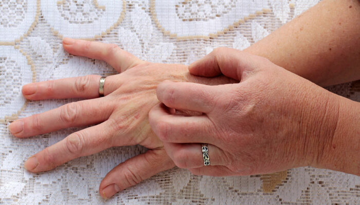 Scabies – Symptoms, Causes, and Treatment Options