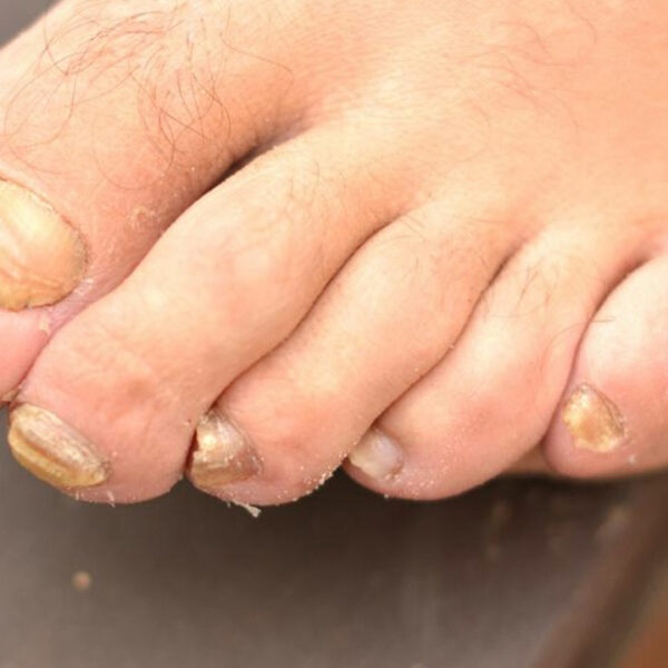 Toenail Fungus – Causes, Symptoms and Treatment