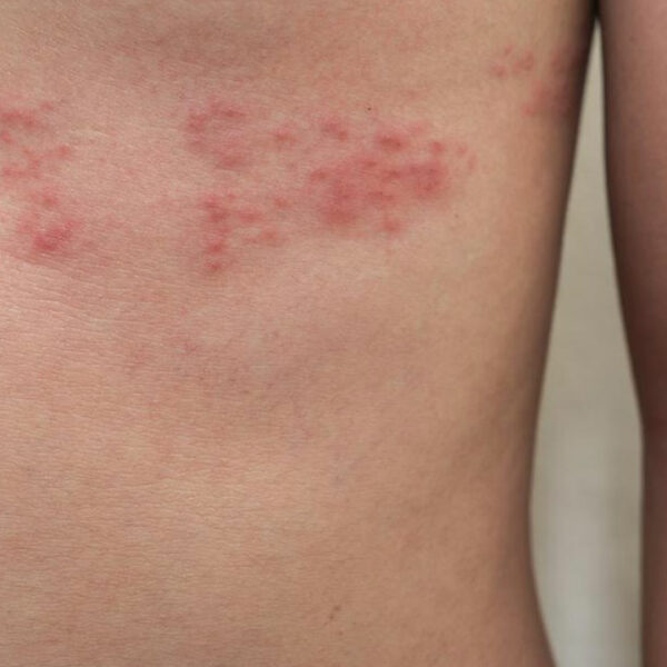 Top 3 Simple Treatments for Shingles You Need to Know